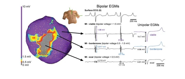 In-vivo electroanatomic map of a chronically infarcted porcine heart. More info in accordion.
